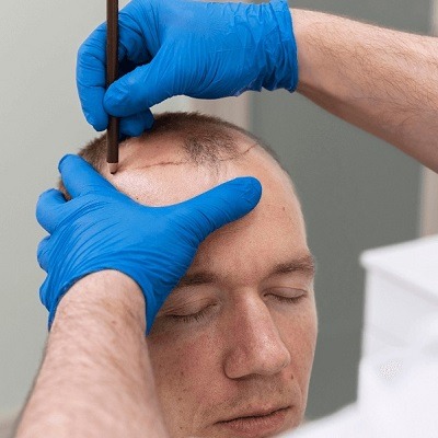جراحة زراعة الشعر بدون ندبات في دبي وأبو ظبي والشارقة كلفة