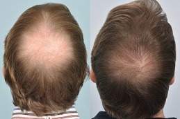 أفضل زراعة شعر التاج في دبي وأبو ظبي