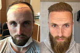 أفضل زراعة شعر للرجال في دبي وأبو ظبي