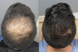 زراعة الشعر التاجي في دبي الإمارات العربية المتحدة