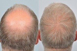 زراعة الشعر التاجي في دبي وأبو ظبي