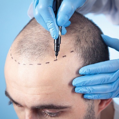 زراعة الشعر بـ 1 درهم