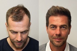 زراعة الشعر للرجال في دبي الإمارات العربية المتحدة
