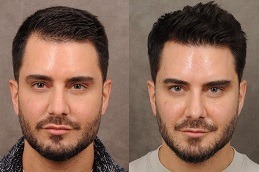 زراعة الشعر للرجال في دبي وأبو ظبي