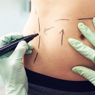 علاج شفط الدهون بالليزر GPS في دبي وأبو ظبي تكلفة نظام تحديد المواقع ليبو