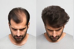 علاجات تساقط الشعر في دبي وأبو ظبي