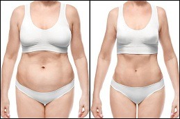 SculpSure نحت الجسم في دبي الإمارات العربية المتحدة