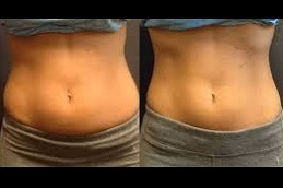 SculpSure نحت الجسم في دبي وأبو ظبي