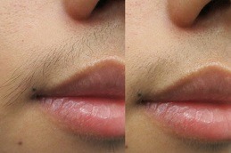 أفضل إزالة الشعر بالليزر في دبي وأبو ظبي