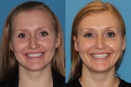 أفضل حقن حشو الخد في دبي وأبو ظبي