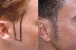 أفضل زراعة شعر السوالف في دبي وأبو ظبي