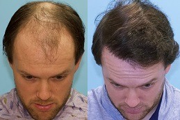 أفضل زراعة شعر بدون ندبات في دبي وأبو ظبي