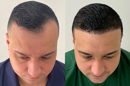 أفضل علاج طبيعي لخط الشعر في دبي وأبو ظبي