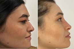 أفضل عملية تجميل أنف غير جراحية في دبي وأبو ظبي