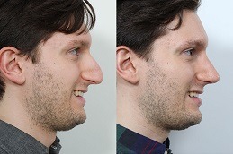 أفضل عملية تجميل الأنف للرجال في دبي وأبو ظبي