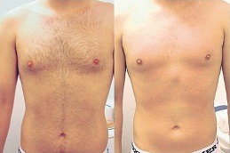 أفضل عيادة إزالة الشعر بالليزر في دبي