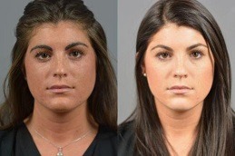 أفضل ليزر فراكشنال مع العلاج بالبلازما الغنية بالصفائح الدموية (PRP) في دبي وأبو ظبي