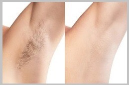 إزالة الشعر بالليزر في دبي الإمارات العربية المتحدة