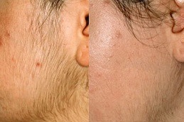 إزالة الشعر بالليزر في دبي وأبو ظبي