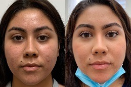 الليزر الجزئي مع العلاج بالبلازما الغنية بالصفائح الدموية (PRP) في دبي وأبو ظبي