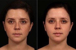 الليزر الجزئي مع العلاج بالبلازما الغنية بالصفائح الدموية (PRP) في دبي، الإمارات العربية المتحدة