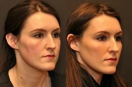 تكلفة حقن حشو الخد في دبي وأبو ظبي