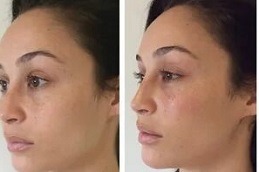 تكلفة حقن حشو الخد في دبي