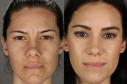 جراحة رفع الحاجب في دبي وأبو ظبي