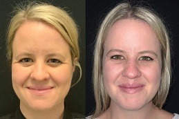 جراحة رفع الحاجب في دبي، الإمارات العربية المتحدة