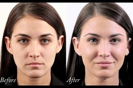 حقن حشو الخد في دبي وأبو ظبي