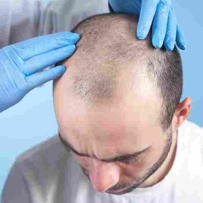 زراعة الشعر بدون حلاقة في دبي