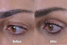 زراعة شعر الرموش في دبي الإمارات العربية المتحدة