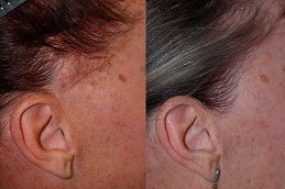 زراعة شعر السوالف في دبي الإمارات العربية المتحدة