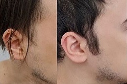 زراعة شعر السوالف في دبي