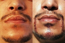 زراعة شعر الشارب في دبي الإمارات العربية المتحدة