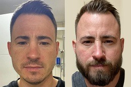 زراعة شعر الشارب في دبي وأبو ظبي