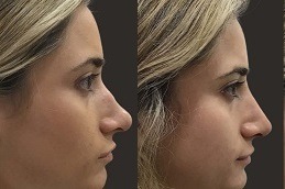 عملية تجميل الأنف غير الجراحية في دبي بالإمارات العربية المتحدة