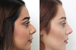 عملية تجميل الأنف غير الجراحية في دبي وأبو ظبي