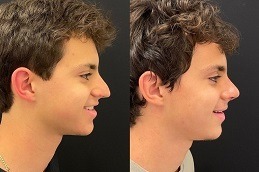 عملية تجميل الأنف للرجال في دبي وأبو ظبي