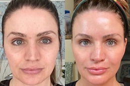 عملية تجميل مصاصي الدماء في دبي وأبو ظبي
