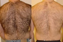 عيادة إزالة الشعر بالليزر في دبي وأبو ظبي