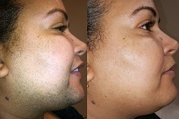 عيادة إزالة الشعر بالليزر في دبي