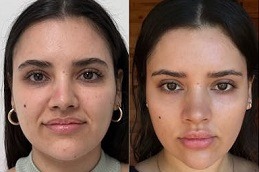 مصاص دماء تجميل في دبي الإمارات العربية المتحدة