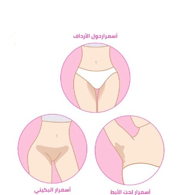 علاج تبييض منطقة البكينيفي في دبي وأبو ظبي