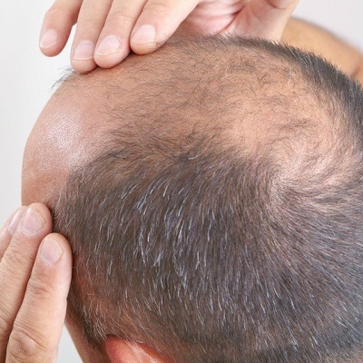 Stem Cell Hair Transplant in Dubai & Abu Dhabi - Cost & Deals Esthetic Care