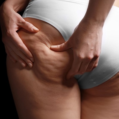Best Cellulite Removal Treatment in Dubai & Abu Dhabi LPG Cellulite