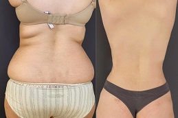 Best Liposuction Surgery Dubai & Abu Dhabi