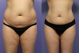 Liposuction Surgery in Dubai UAE