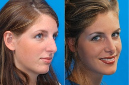 Best Cheek Augmentation Dubai & Abu Dhabi