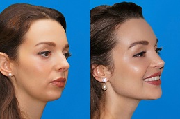 Cheek Augmentation in Dubai & Abu Dhabi